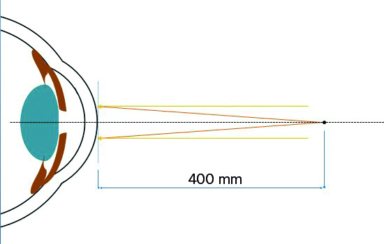 lente-a-contatto-vs-correzione-oftalmica-implicazioni-refrattive-accomodative-e-binoculari
