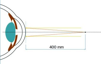 Lente a contatto vs correzione oftalmica: implicazioni refrattive, accomodative e binoculari – Parte 1